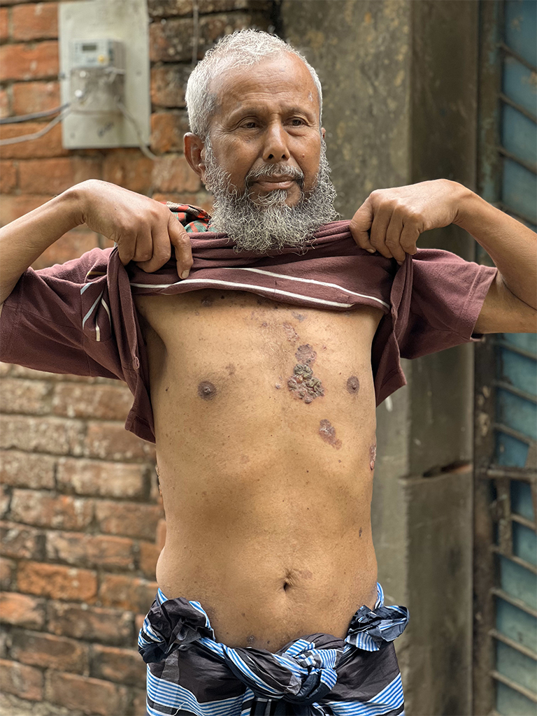 A man shows rashes on his skin.